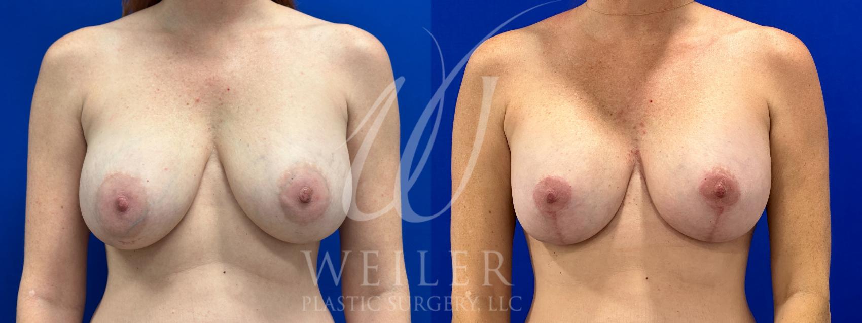 Before & After Breast Revision Case 1100 Front View in Baton Rouge, New Orleans, & Lafayette, Louisiana