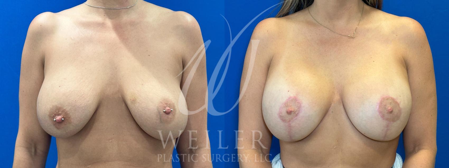 Before & After Breast Revision Case 1104 Front View in Baton Rouge, New Orleans, & Lafayette, Louisiana