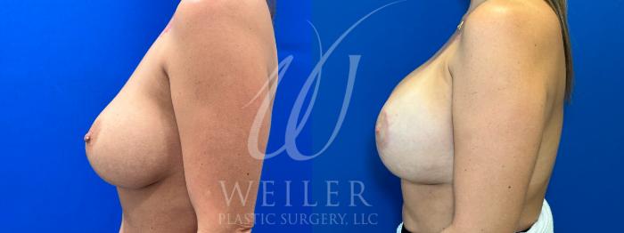 Before & After Breast Lift with Augmentation Case 1104 Right Side View in Baton Rouge, New Orleans, & Lafayette, Louisiana