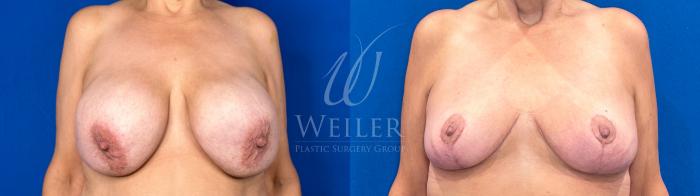 Before & After Breast Revision Case 1189 Front View in Baton Rouge, Louisiana