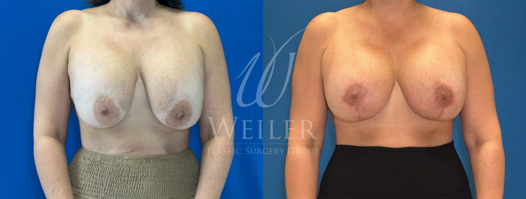 Before & After Breast Revision Case 1287 Front View in Baton Rouge, New Orleans, & Lafayette, Louisiana