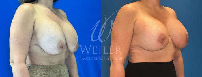 Before & After Breast Revision Case 1287 Right Oblique View in Baton Rouge, New Orleans, & Lafayette, Louisiana