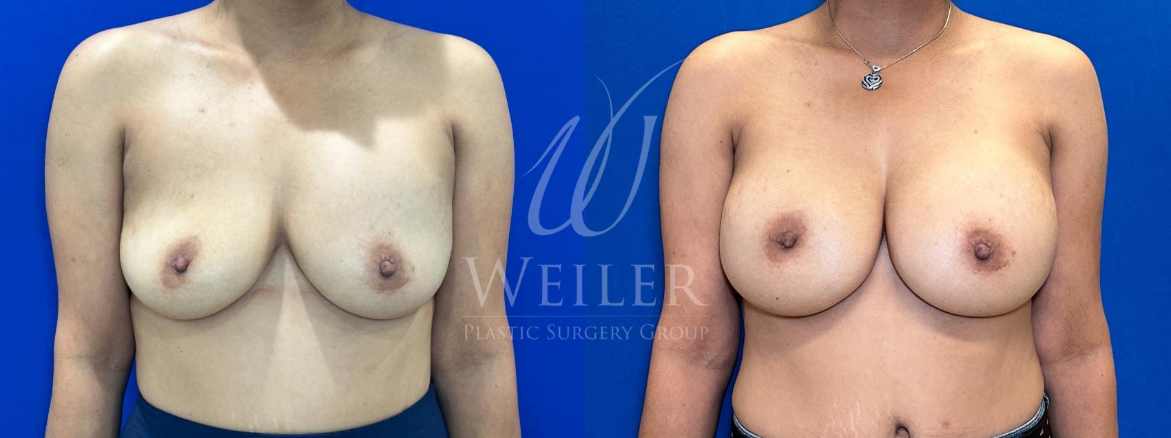 Before & After Breast Revision Case 1291 Front View in Baton Rouge, New Orleans, & Lafayette, Louisiana