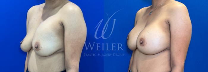 Before & After Breast Revision Case 1291 Left Oblique View in Baton Rouge, New Orleans, & Lafayette, Louisiana