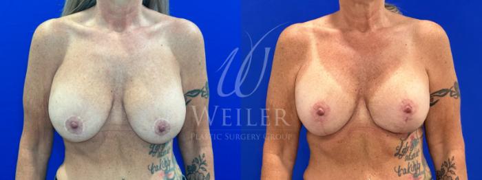 Before & After Breast Revision Case 1309 Front View in Baton Rouge, New Orleans, & Lafayette, Louisiana