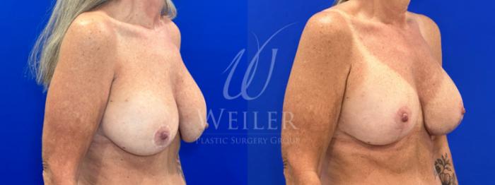 Before & After Breast Revision Case 1309 Left Oblique View in Baton Rouge, New Orleans, & Lafayette, Louisiana