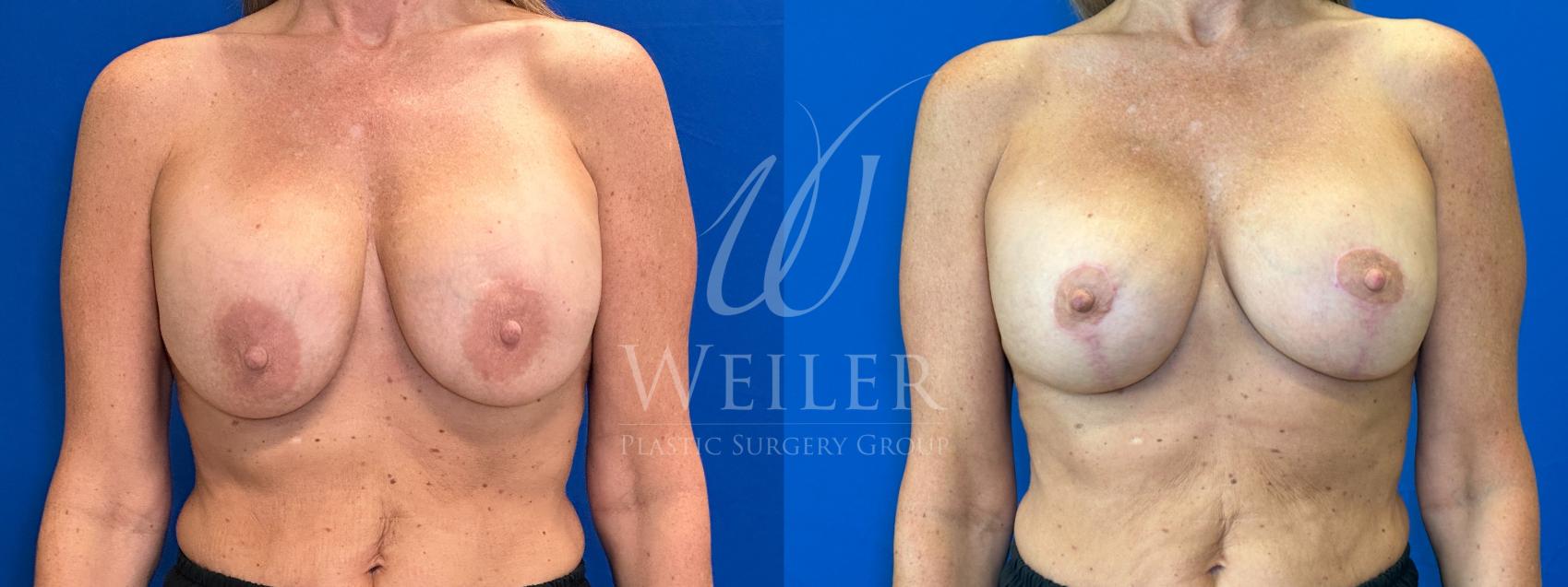 Before & After Breast Revision Case 1409 Front View in Baton Rouge, New Orleans, & Lafayette, Louisiana