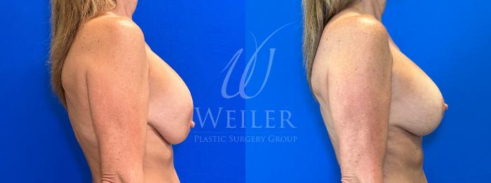 Before & After Breast Revision Case 1409 Right Side View in Baton Rouge, New Orleans, & Lafayette, Louisiana