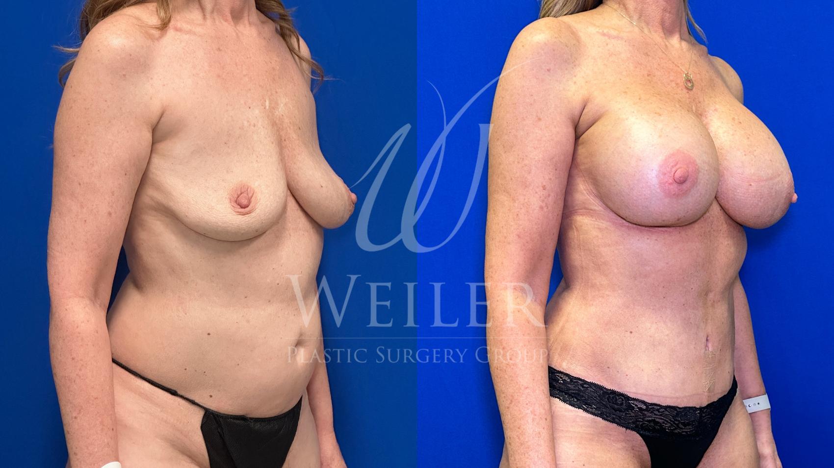 Before & After Mommy Makeover Case 1467 Right Side View in Baton Rouge, New Orleans, & Lafayette, Louisiana