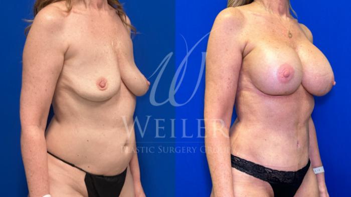 Before & After Mommy Makeover Case 1467 Right Side View in Baton Rouge, New Orleans, & Lafayette, Louisiana