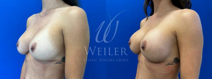 Before & After Breast Revision Case 1605 Left Oblique View in Baton Rouge, New Orleans, & Lafayette, Louisiana