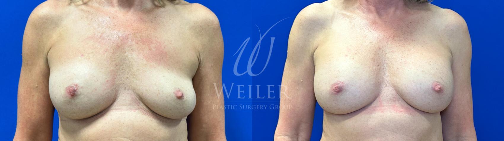 Before & After Breast Revision Case 1770 Front View in Baton Rouge, New Orleans, & Lafayette, Louisiana
