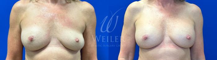 Before & After Breast Revision Case 1770 Front View in Baton Rouge, New Orleans, & Lafayette, Louisiana