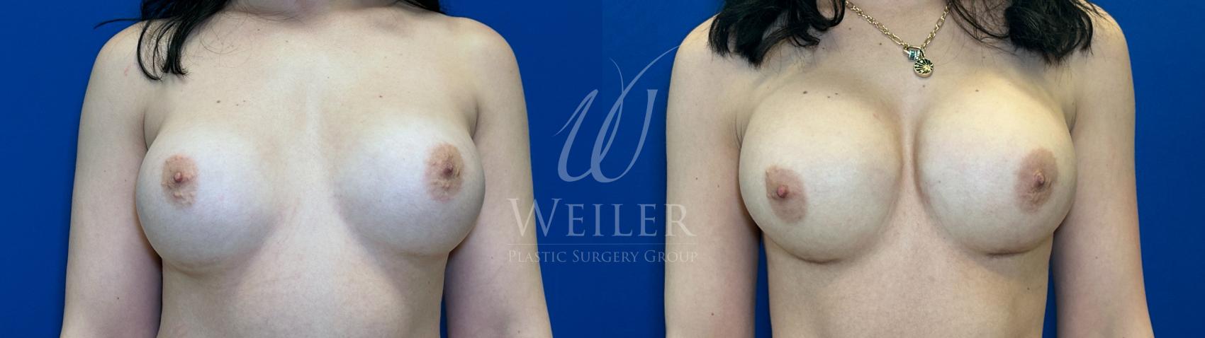 Before & After Breast Revision Case 1807 Front View in Baton Rouge, New Orleans, & Lafayette, Louisiana