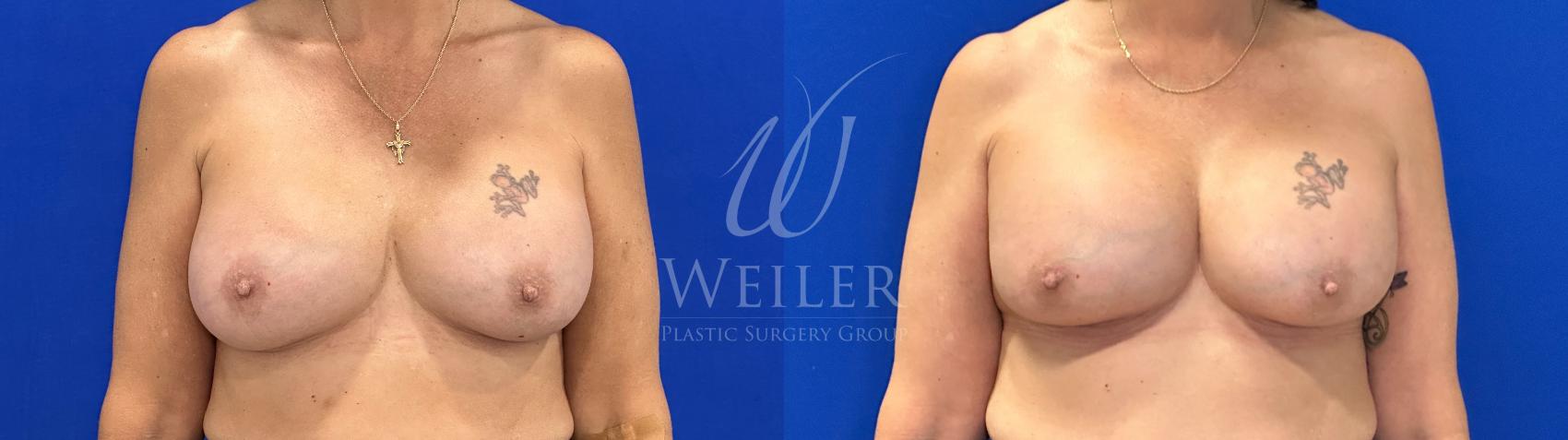 Before & After Breast Revision Case 1808 Front View in Baton Rouge, New Orleans, & Lafayette, Louisiana