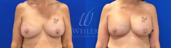 Before & After Breast Revision Case 1808 Front View in Baton Rouge, New Orleans, & Lafayette, Louisiana