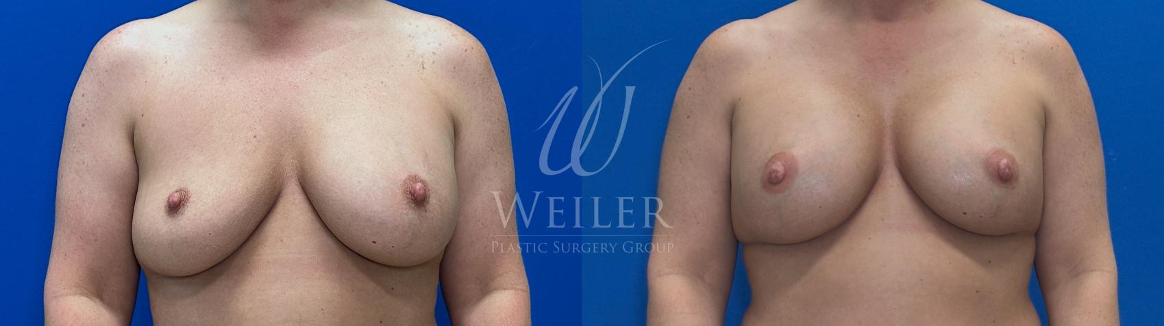 Before & After Breast Revision Case 1809 Front View in Baton Rouge, New Orleans, & Lafayette, Louisiana