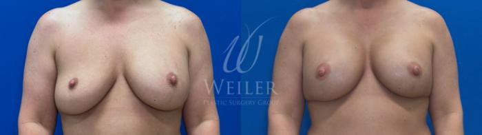 Before & After Breast Revision Case 1809 Front View in Baton Rouge, New Orleans, & Lafayette, Louisiana