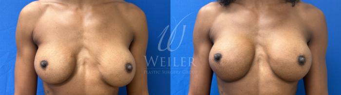 Before & After Breast Revision Case 1810 Front View in Baton Rouge, New Orleans, & Lafayette, Louisiana