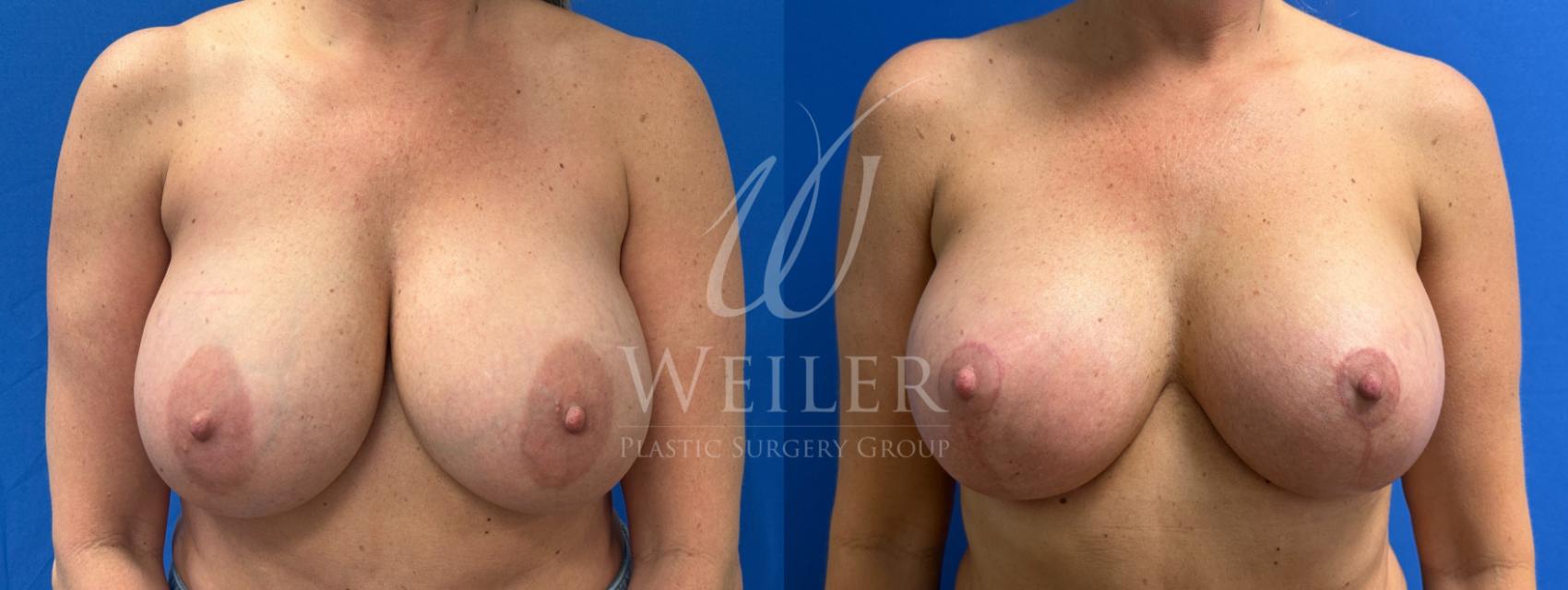 Before & After Breast Revision Case 1822 Front View in Baton Rouge, New Orleans, & Lafayette, Louisiana