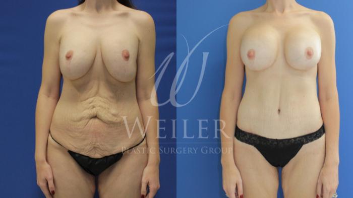 Before & After Breast Revision Case 808 Front View in Baton Rouge, New Orleans, & Lafayette, Louisiana