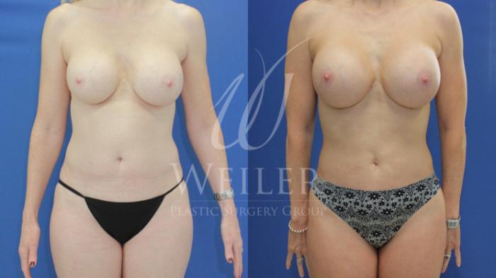 Before & After Breast Revision Case 832 Front View in Baton Rouge, Louisiana