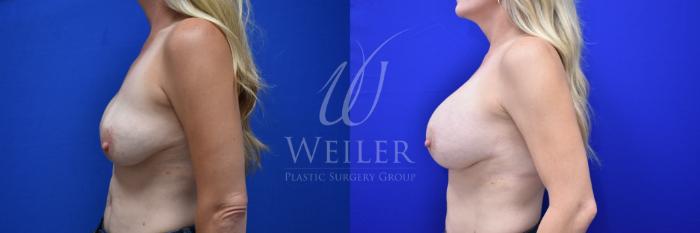 Before & After Breast Revision Case 834 Left Side View in Baton Rouge, Louisiana