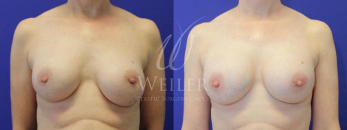 Before & After Breast Revision Case 842 Front View in Baton Rouge, New Orleans, & Lafayette, Louisiana