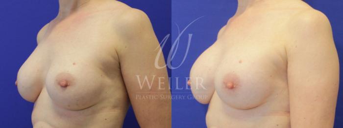 Before & After Breast Revision Case 842 Left Oblique View in Baton Rouge, New Orleans, & Lafayette, Louisiana