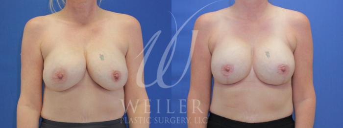 Before & After Breast Revision Case 911 Front View in Baton Rouge, New Orleans, & Lafayette, Louisiana