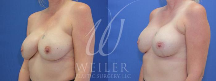 Before & After Breast Revision Case 911 Left Oblique View in Baton Rouge, New Orleans, & Lafayette, Louisiana