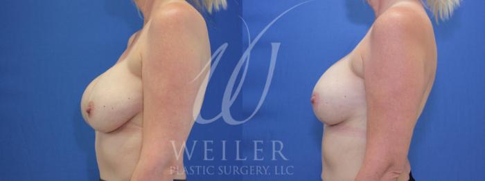 Before & After Breast Revision Case 911 Left Side View in Baton Rouge, New Orleans, & Lafayette, Louisiana