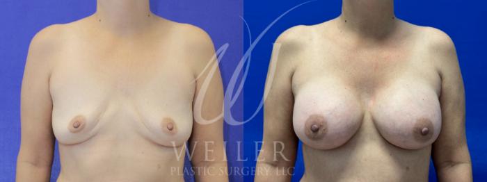 Before & After Breast Revision Case 966 Front View in Baton Rouge, New Orleans, & Lafayette, Louisiana