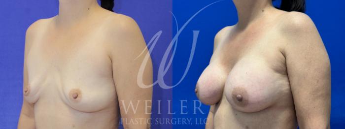 Before & After Breast Revision Case 966 Left Oblique View in Baton Rouge, New Orleans, & Lafayette, Louisiana