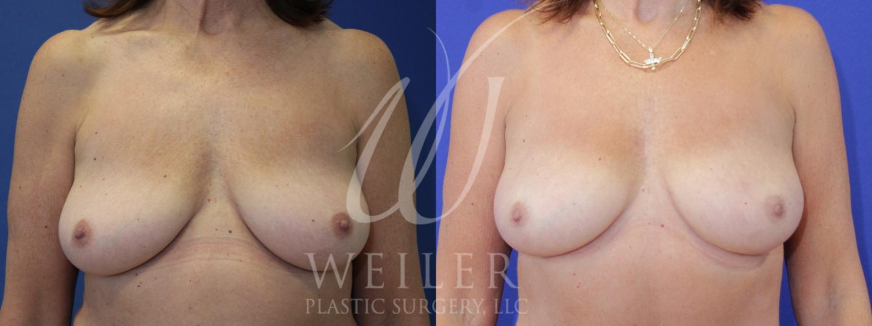 Before & After Breast Revision Case 967 Front View in Baton Rouge, Louisiana