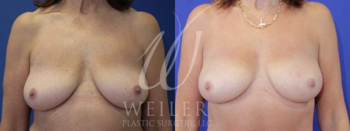 Before & After Breast Revision Case 967 Front View in Baton Rouge, Louisiana