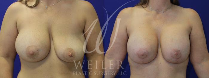 Before & After Breast Revision Case 981 Front View in Baton Rouge, New Orleans, & Lafayette, Louisiana