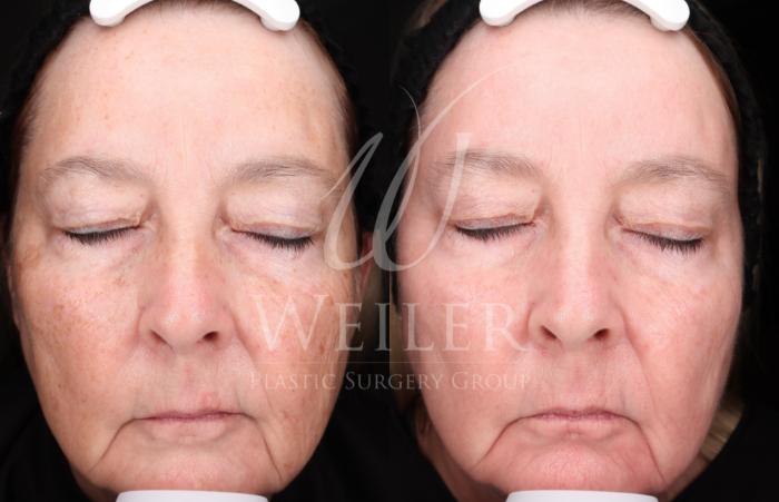 Before & After Chemical Peels Case 1421 Front View in Baton Rouge, New Orleans, & Lafayette, Louisiana