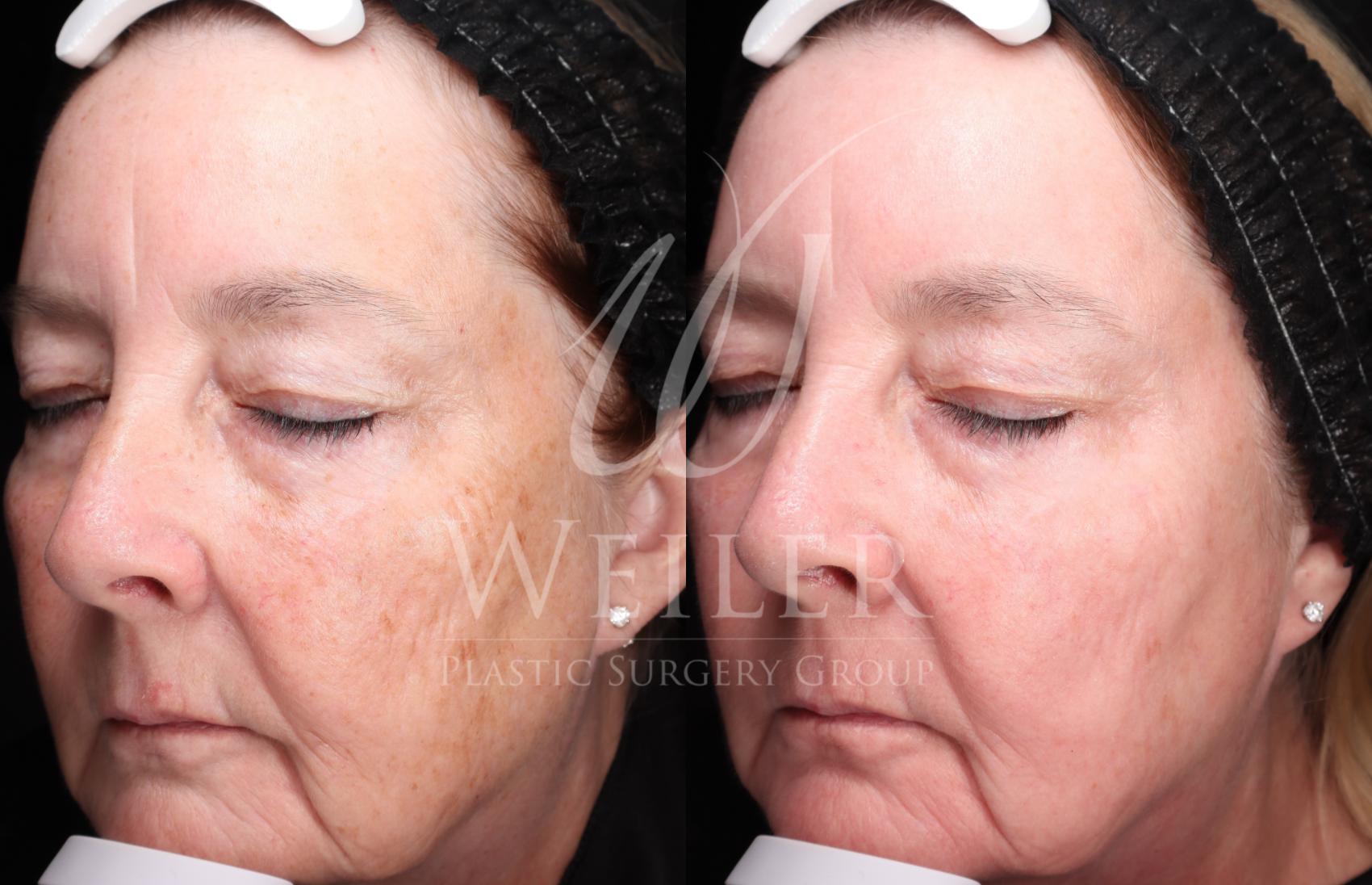 Before & After Chemical Peels Case 1421 Left Oblique View in Baton Rouge, New Orleans, & Lafayette, Louisiana