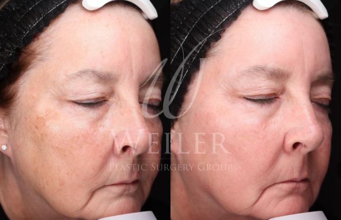 Before & After Chemical Peels Case 1421 Right Oblique View in Baton Rouge, New Orleans, & Lafayette, Louisiana