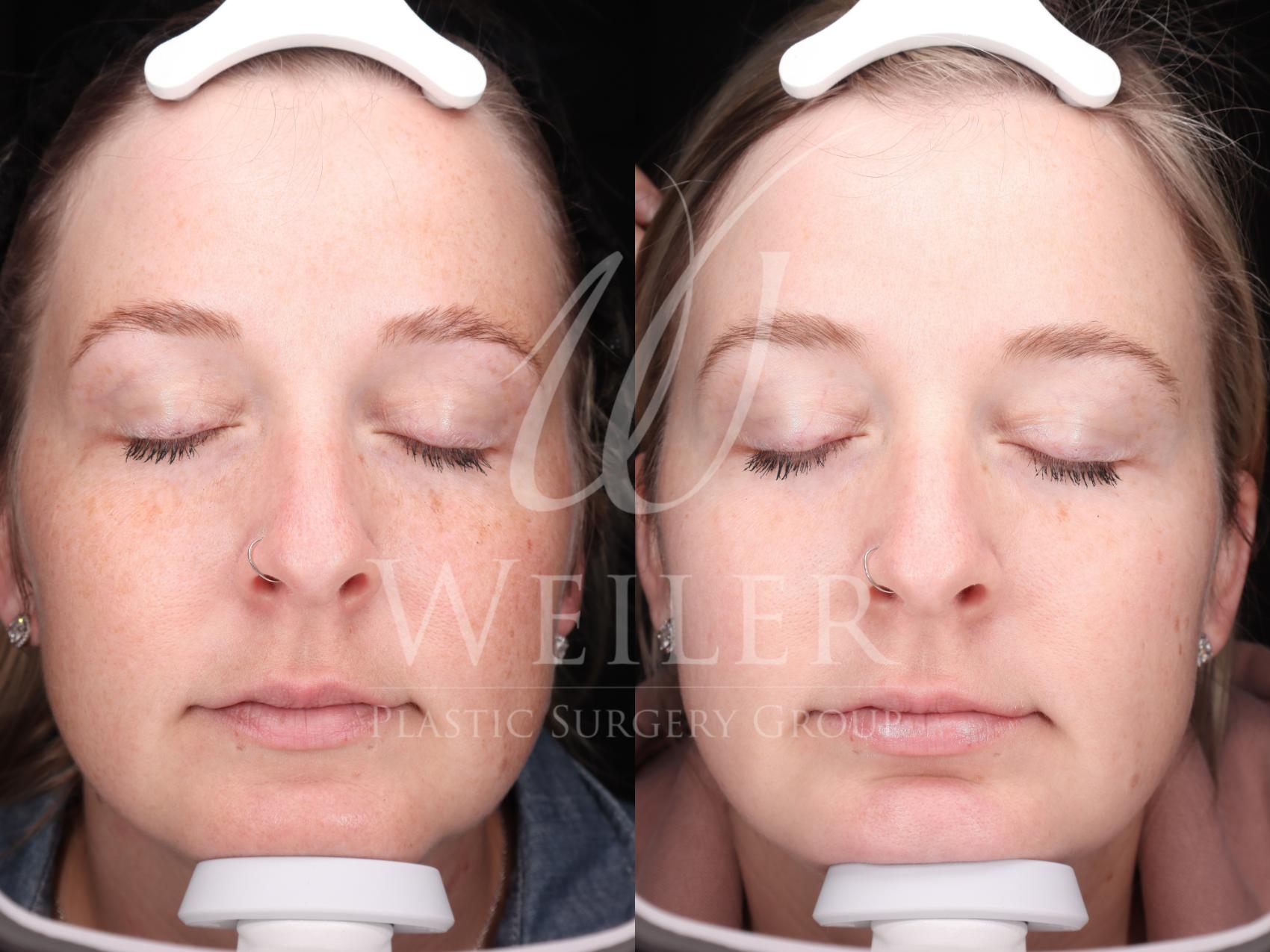 Before & After Chemical Peels Case 1422 Front View in Baton Rouge, New Orleans, & Lafayette, Louisiana