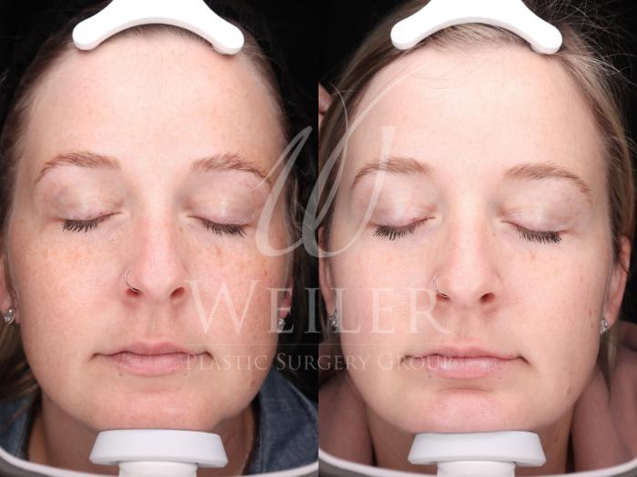 Before & After Chemical Peels Case 1422 Front View in Baton Rouge, New Orleans, & Lafayette, Louisiana