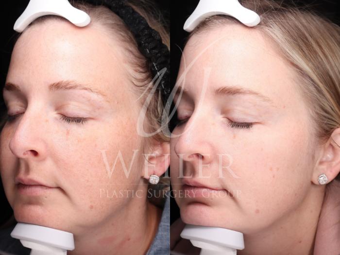 Before & After Chemical Peels Case 1422 Left Oblique View in Baton Rouge, New Orleans, & Lafayette, Louisiana