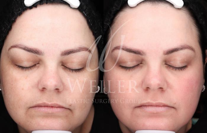 Before & After Chemical Peels Case 1423 Front View in Baton Rouge, New Orleans, & Lafayette, Louisiana