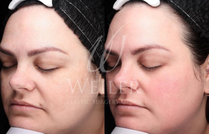 Before & After Chemical Peels Case 1423 Left Oblique View in Baton Rouge, New Orleans, & Lafayette, Louisiana