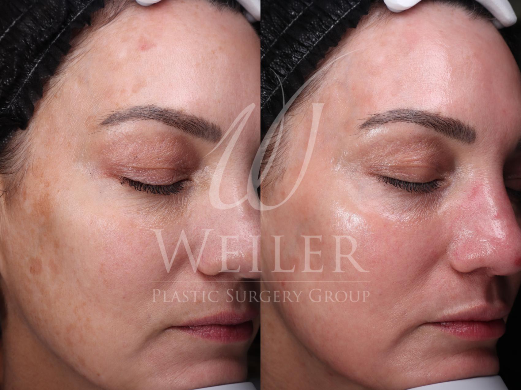 Before & After Chemical Peels Case 1598 Right Oblique View in Baton Rouge, New Orleans, & Lafayette, Louisiana