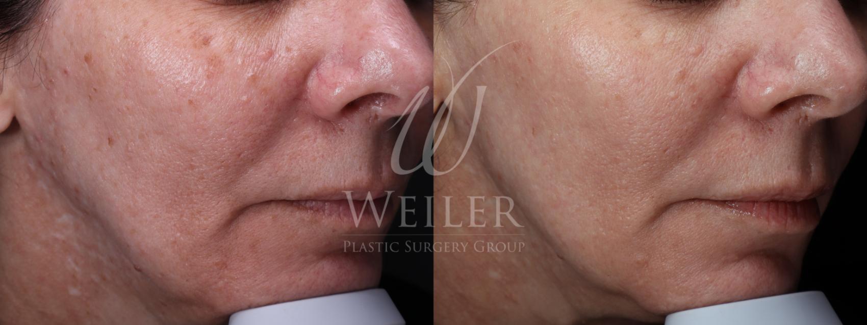 Before & After Chemical Peels Case 1625 Right Oblique View in Baton Rouge, New Orleans, & Lafayette, Louisiana