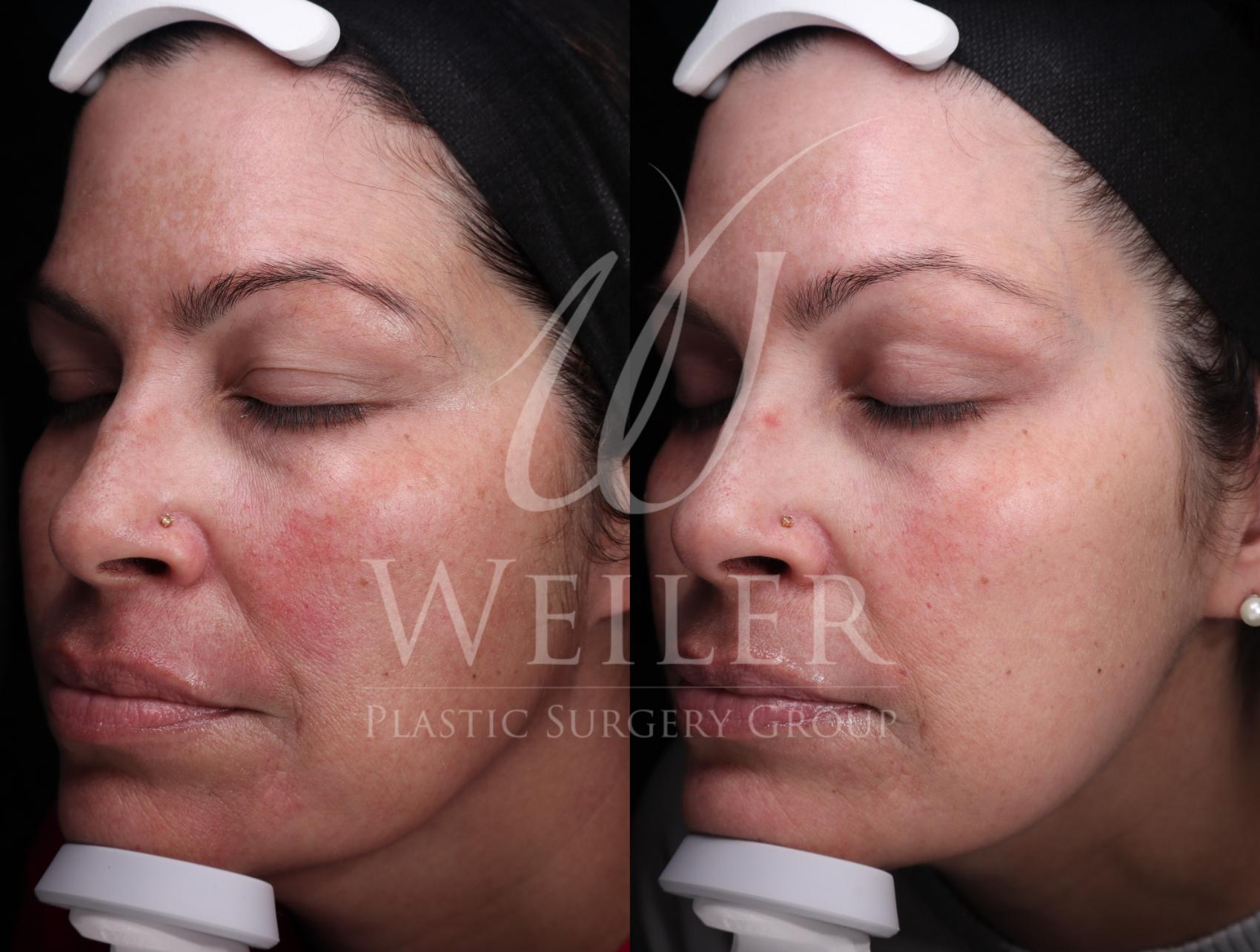 glutathione on amazon Why Do Boogers Increase After Rhinoplasty Surgery? main image 1