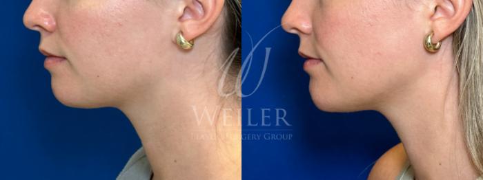 Before & After Chin Augmentation Case 1106 Left Side View in Baton Rouge, New Orleans, & Lafayette, Louisiana