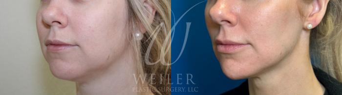 Before & After Chin Augmentation Case 1107 Left Oblique View in Baton Rouge, New Orleans, & Lafayette, Louisiana